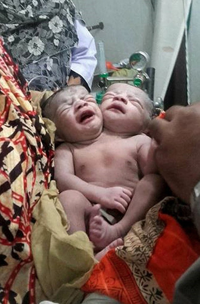 İki başlı bebek doğdu - Resim: 1