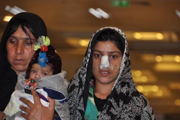 Kocasının burnunu kestiği Afgan kadın tedavi için Türkiye'ye geldi - Resim: 2