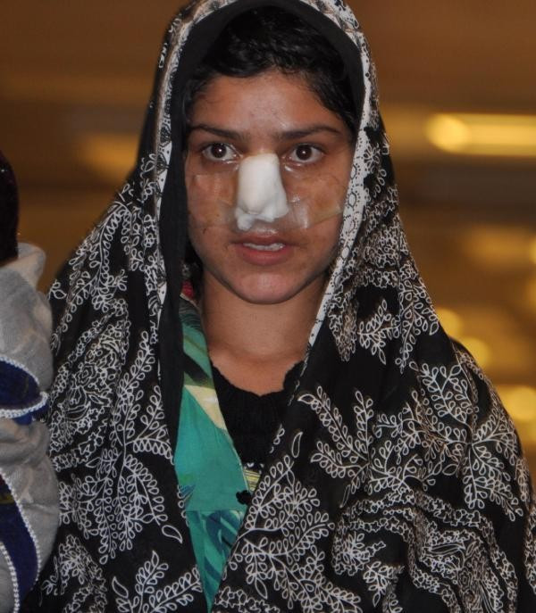 Kocasının burnunu kestiği Afgan kadın tedavi için Türkiye'ye geldi - Resim: 3