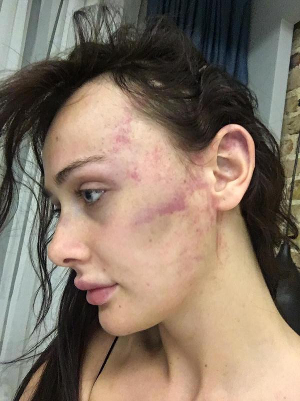 Sırp model Tanja Dukiç'e Türk sevgili dayağı: Bacaklarıma vurdu, altıma işedim, kulağımdan kan geldi - Resim: 3