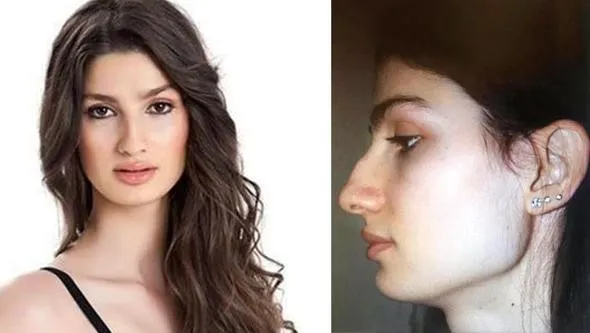Best Model of Turkey 2016 birincisinden burun estetiği