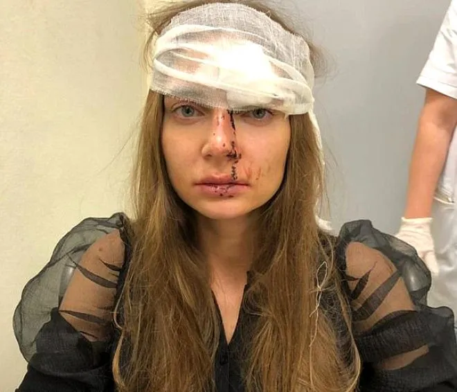 Dudaklarına silikon yaptırmak isteyen Rus şarkıcı Valentina Sidorova'ya doktoru saldırdı!