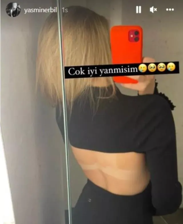 Yasmin Erbil'den Sütyensiz Paylaşım Sırtındaki İzi Gösterdi