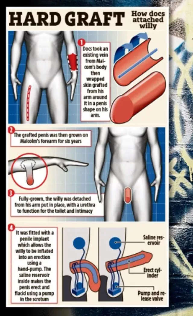 Kolunda Penis İle Yaşadı 6 Yıl Sonra Doğru Yere Konuldu!