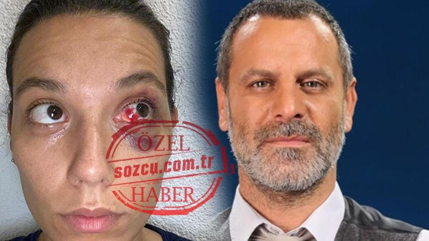Deniz Bulutsuz: Saçlarımdan tutup duvara vurdu, abajurla yaraladı - Resim: 1