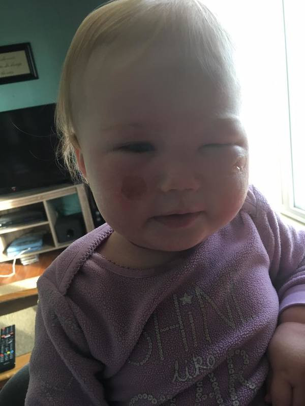 Büyük tehlike: Bebeğin önce suratı yandı sonra soyuldu - Resim: 1