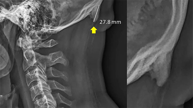 Cep telefonunu fazla kullanmak kafada boynuz çıkartıyor - Resim: 1