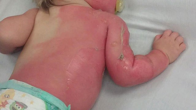 Annesi tarafından havuza sokulan 9 aylık bebeğin vücudunun yüzde 30'u yandı - Resim: 1