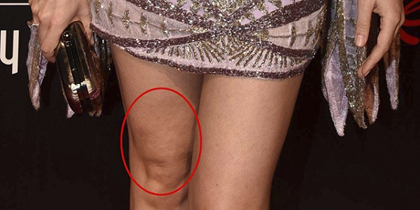 Fahriye Evcen'in selülitli ve varisli bacakları şoke etti! - Resim: 1