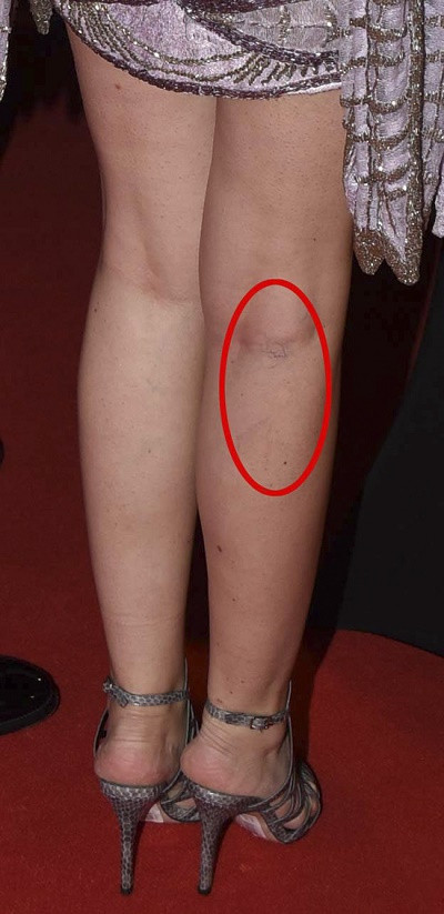 Fahriye Evcen'in selülitli ve varisli bacakları şoke etti! - Resim: 2