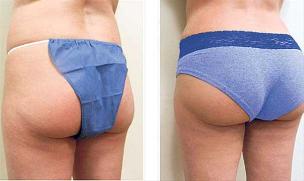 Popo estetiği ameliyatında merkez İstanbul oldu! - Resim: 2