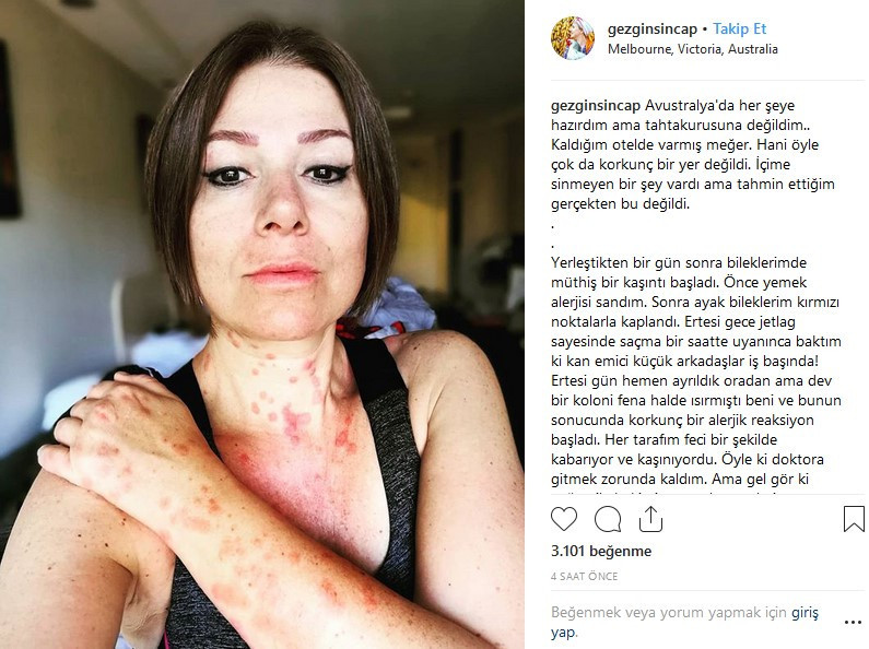 Mutlu Tönbekici oteldeki tahta kuruları yüzünden bu hale geldi - Resim: 1