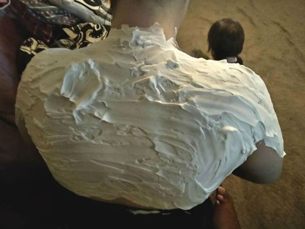 Güneş yanığı için ucuz ve pratik tedavi yöntemi - Resim: 3