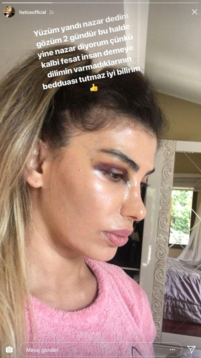 Kalçasıyla gündeme gelen Hatice'nin son hali korkuttu - Resim: 1