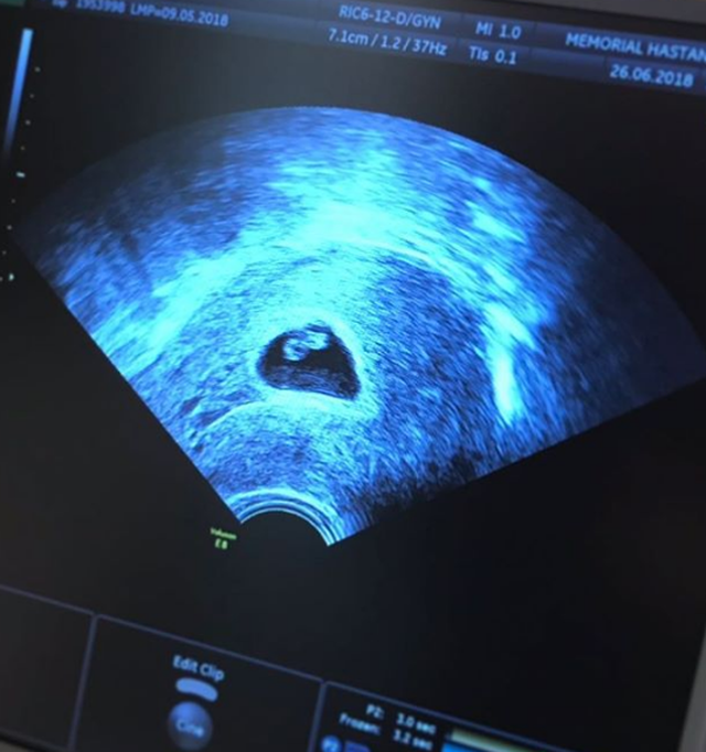 47 yaşında hamile kalan Siren Ertan’ın bebeğinden üzücü haber - Resim: 1