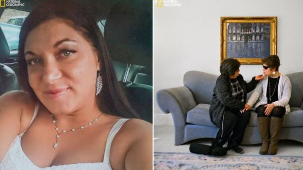 İntihar girişiminden canlı çıkan kız yüz nakli ile yeni hayatına başladı - Resim: 1