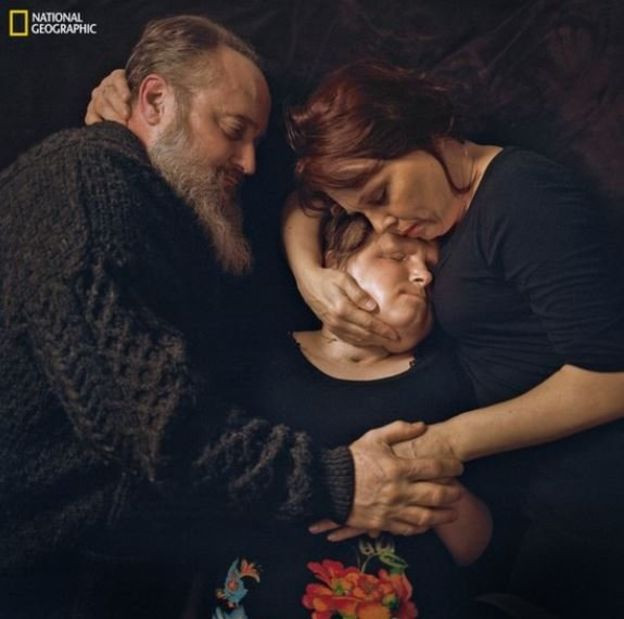 İntihar girişiminden canlı çıkan kız yüz nakli ile yeni hayatına başladı - Resim: 2